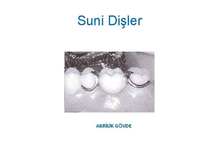 Suni Dişler AKRİLİK GÖVDE 