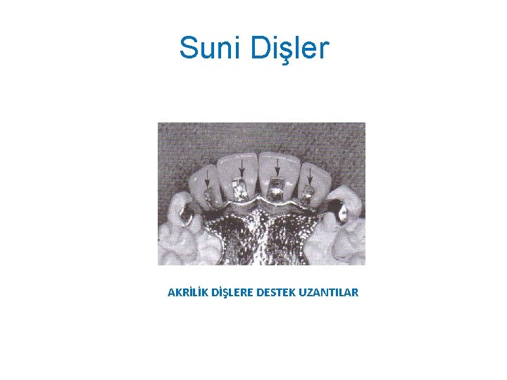 Suni Dişler AKRİLİK DİŞLERE DESTEK UZANTILAR 