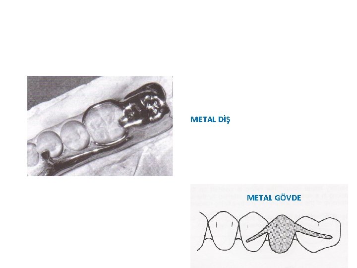 METAL DİŞ METAL GÖVDE 