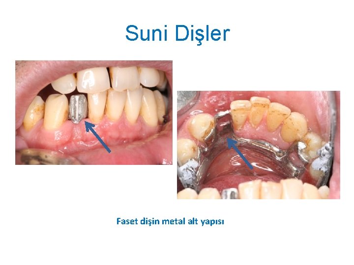 Suni Dişler Faset dişin metal alt yapısı 