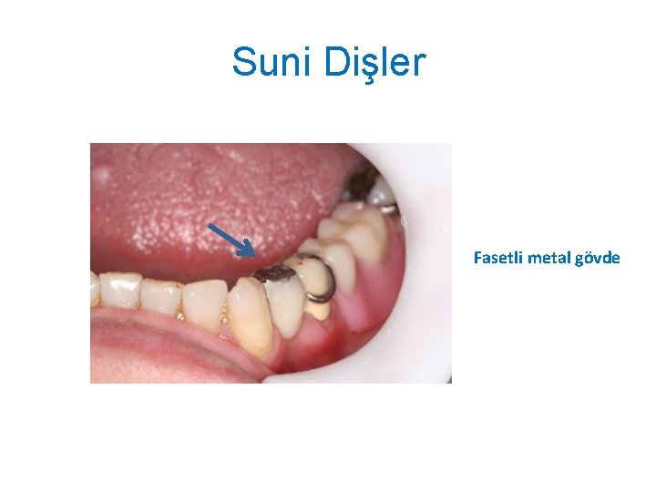 Suni Dişler Fasetli metal gövde 