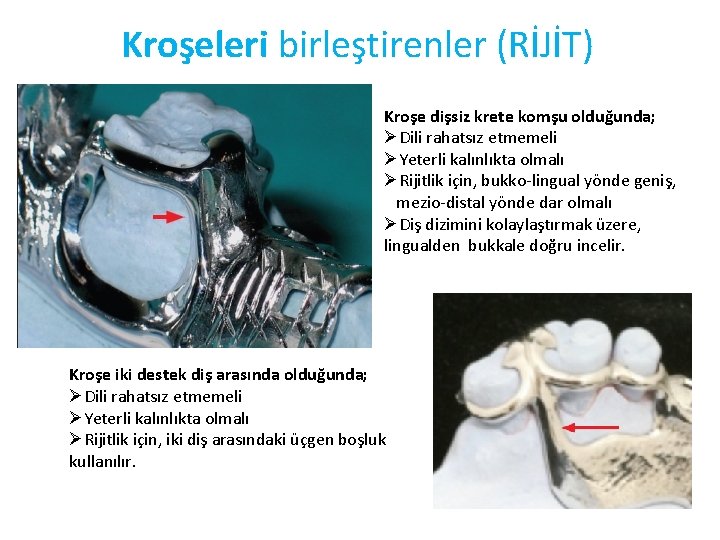 Kroşeleri birleştirenler (RİJİT) Kroşe dişsiz krete komşu olduğunda; ØDili rahatsız etmemeli ØYeterli kalınlıkta olmalı