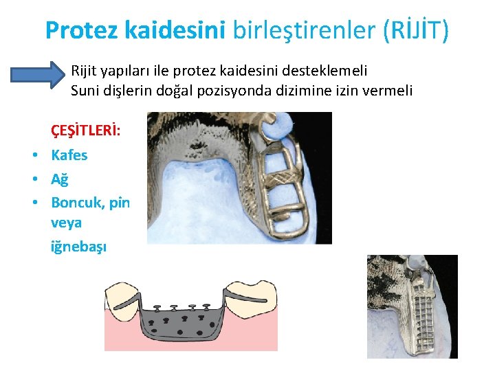 Protez kaidesini birleştirenler (RİJİT) Rijit yapıları ile protez kaidesini desteklemeli Suni dişlerin doğal pozisyonda