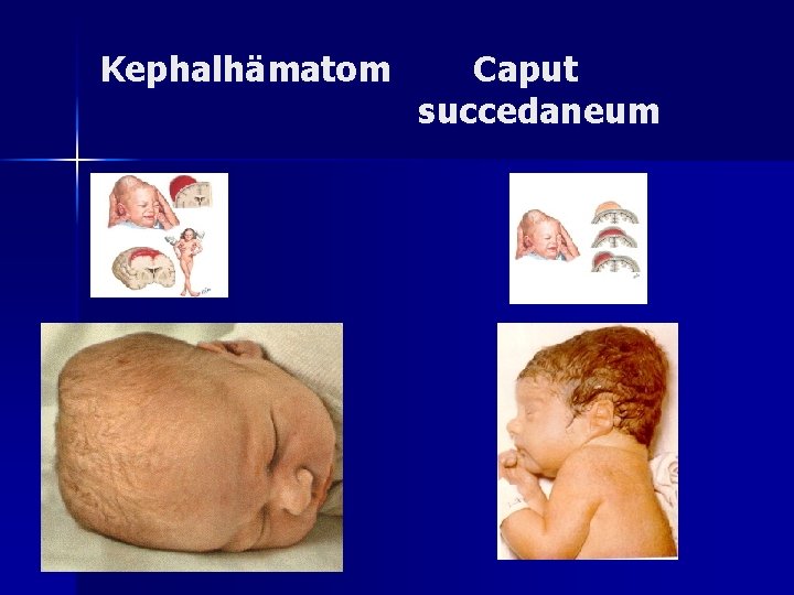 Kephalhämatom Caput succedaneum Kephalhämatom Caput succedaneum