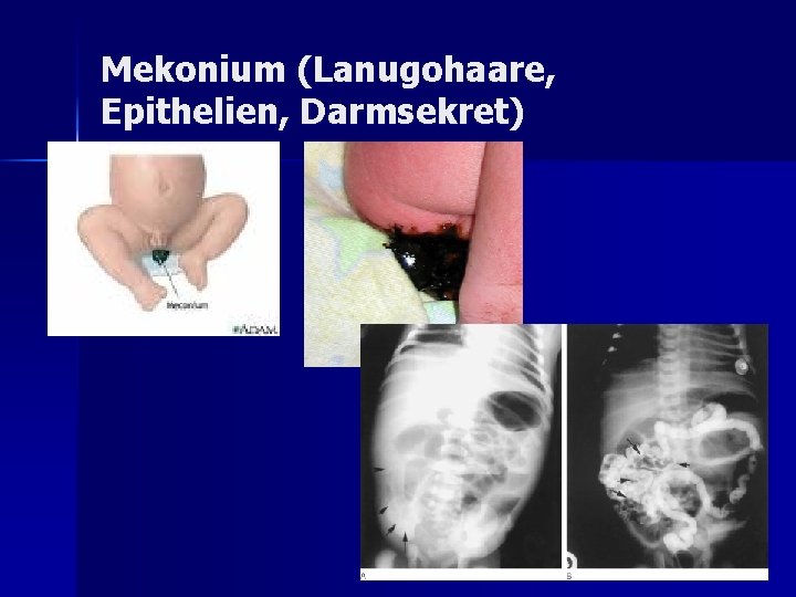 Mekonium (Lanugohaare, Epithelien, Darmsekret) Mekonium (Lanugohaare, Epithelien, Darmsekret)
