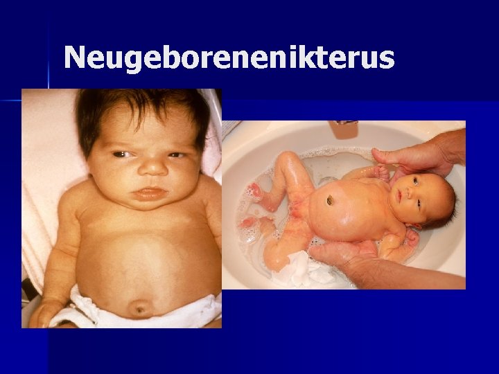Neugeborenenikterus Neugeborenenikterus