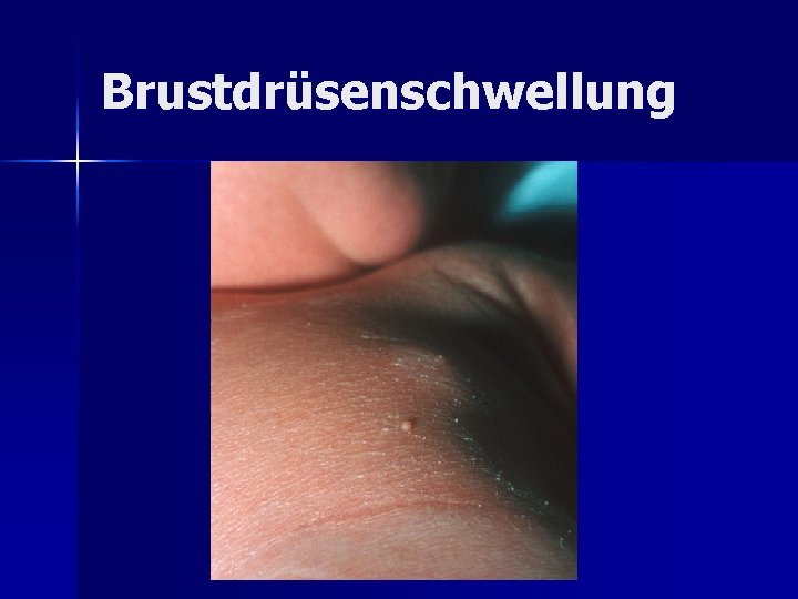 Brustdrüsenschwellung Brustdrüsenschwellung