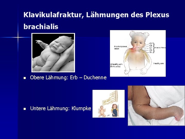 Klavikulafraktur, Lähmungen des Plexus brachialis n Obere Lähmung: Erb – Duchenne n Untere Lähmung: Klavikulafraktur, Lähmungen des Plexus brachialis n Obere Lähmung: Erb – Duchenne n Untere Lähmung: