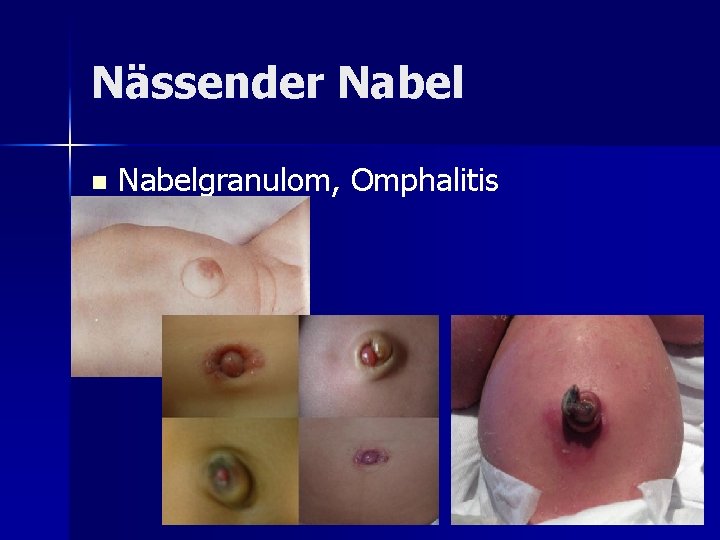 Nässender Nabel n Nabelgranulom, Omphalitis Nässender Nabel n Nabelgranulom, Omphalitis