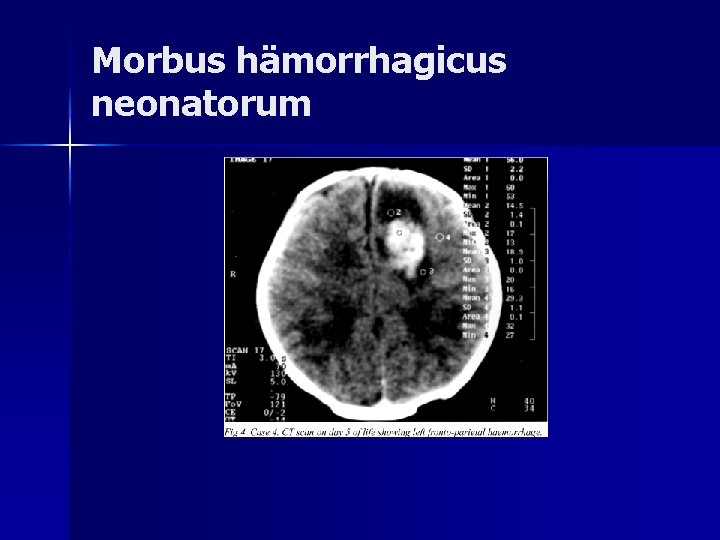 Morbus hämorrhagicus neonatorum Morbus hämorrhagicus neonatorum
