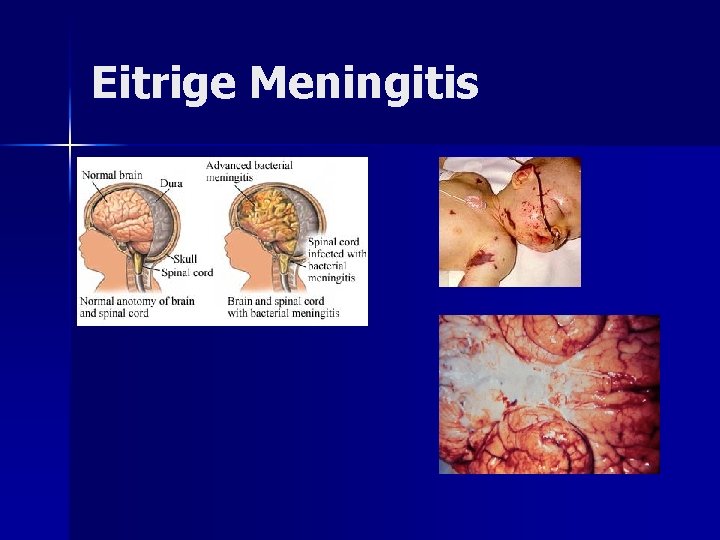 Eitrige Meningitis Eitrige Meningitis