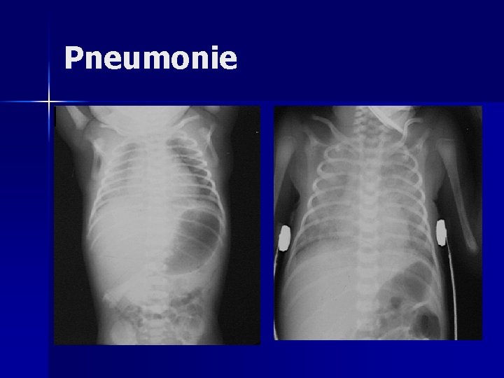 Pneumonie Pneumonie