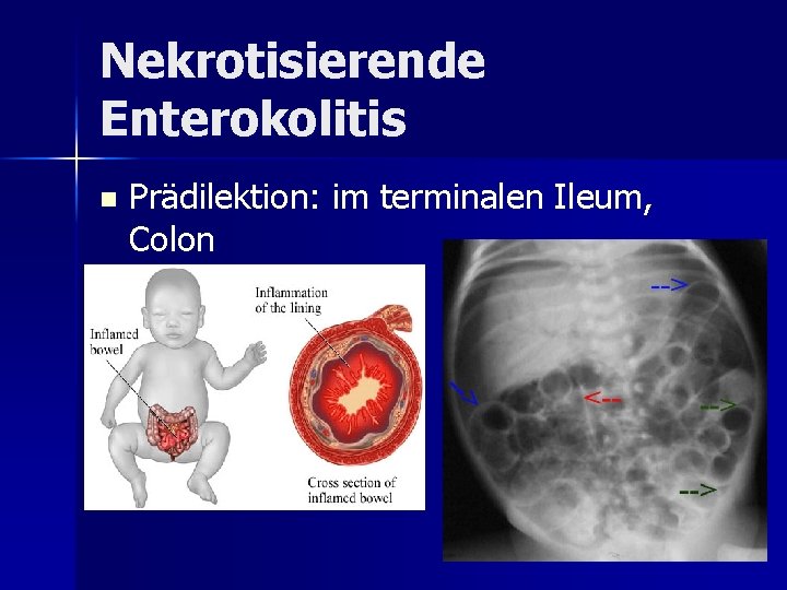 Nekrotisierende Enterokolitis n Prädilektion: im terminalen Ileum, Colon Nekrotisierende Enterokolitis n Prädilektion: im terminalen Ileum, Colon