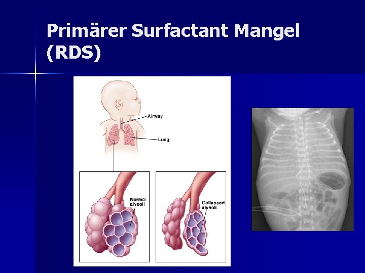 Primärer Surfactant Mangel (RDS) Primärer Surfactant Mangel (RDS)