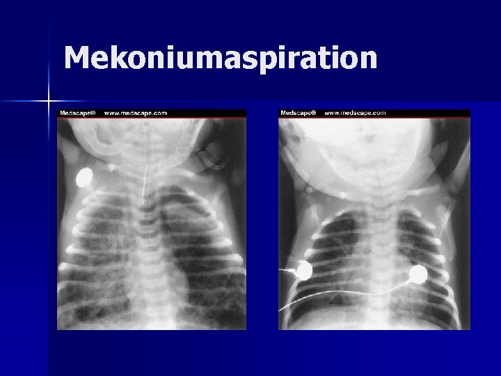 Mekoniumaspiration Mekoniumaspiration