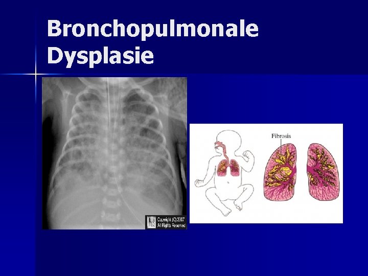 Bronchopulmonale Dysplasie Bronchopulmonale Dysplasie
