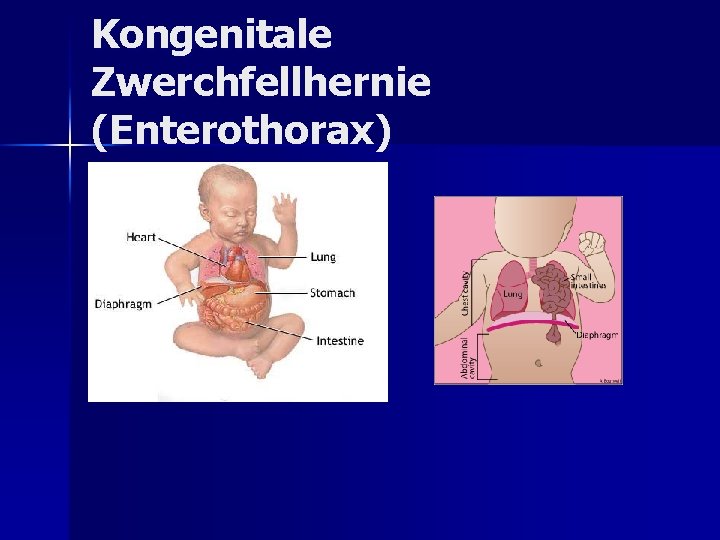 Kongenitale Zwerchfellhernie (Enterothorax) Kongenitale Zwerchfellhernie (Enterothorax)