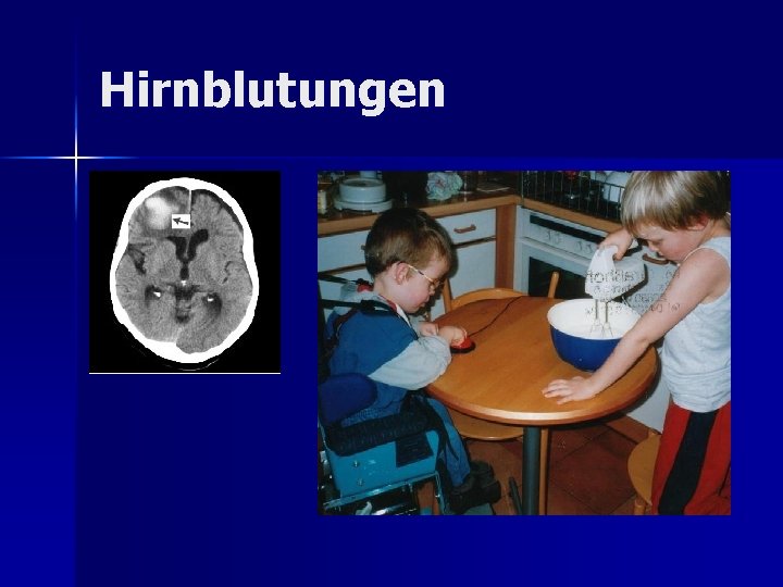 Hirnblutungen Hirnblutungen