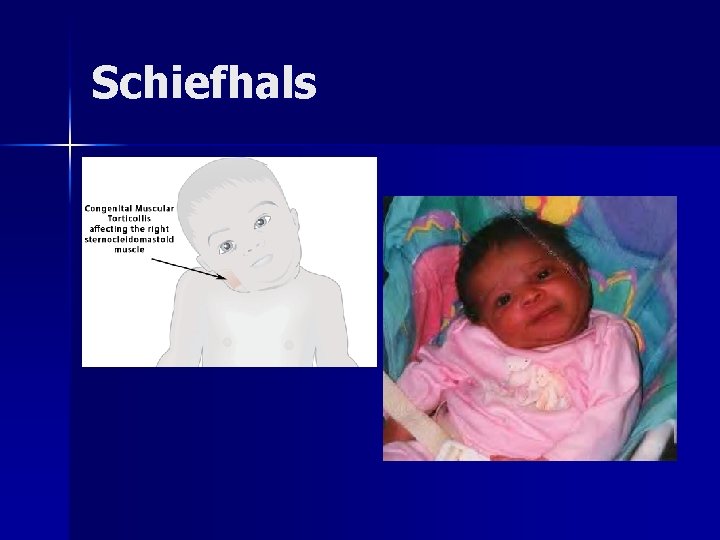 Schiefhals Schiefhals