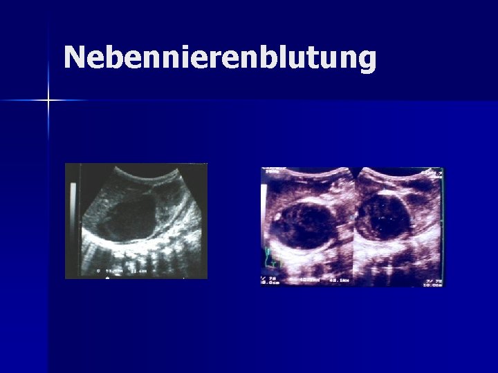 Nebennierenblutung Nebennierenblutung