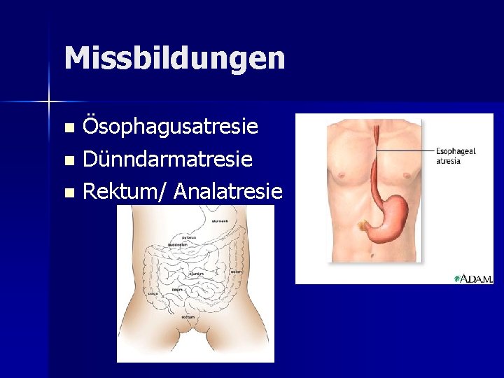 Missbildungen Ösophagusatresie n Dünndarmatresie n Rektum/ Analatresie n Missbildungen Ösophagusatresie n Dünndarmatresie n Rektum/ Analatresie n