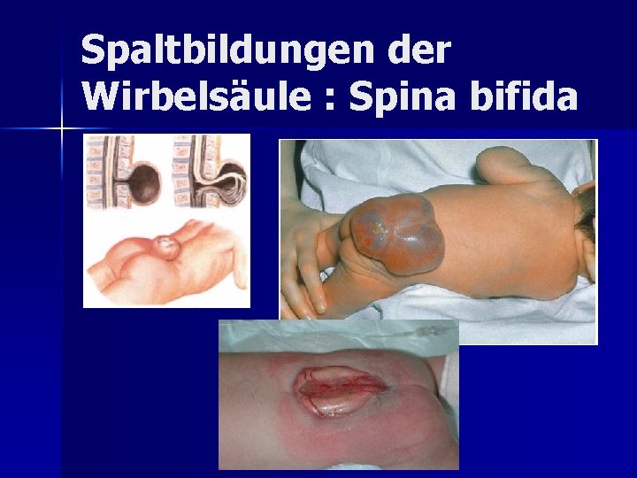 Spaltbildungen der Wirbelsäule : Spina bifida Spaltbildungen der Wirbelsäule : Spina bifida