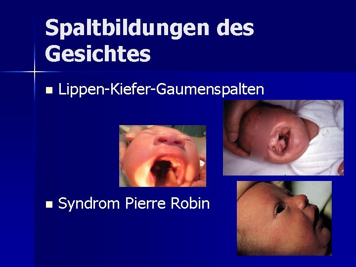 Spaltbildungen des Gesichtes n Lippen-Kiefer-Gaumenspalten n Syndrom Pierre Robin Spaltbildungen des Gesichtes n Lippen-Kiefer-Gaumenspalten n Syndrom Pierre Robin