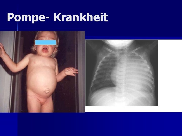 Pompe- Krankheit Pompe- Krankheit