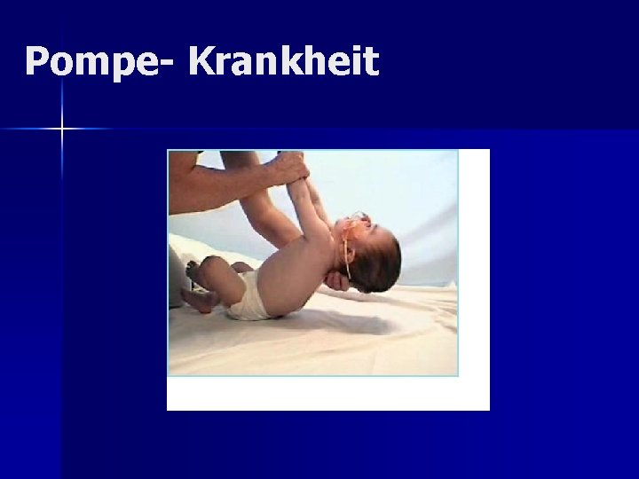 Pompe- Krankheit Pompe- Krankheit