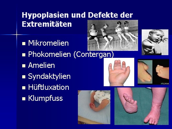 Hypoplasien und Defekte der Extremitäten Mikromelien n Phokomelien (Contergan) n Amelien n Syndaktylien n Hypoplasien und Defekte der Extremitäten Mikromelien n Phokomelien (Contergan) n Amelien n Syndaktylien n
