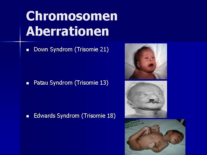 Chromosomen Aberrationen n Down Syndrom (Trisomie 21) n Patau Syndrom (Trisomie 13) n Edwards Chromosomen Aberrationen n Down Syndrom (Trisomie 21) n Patau Syndrom (Trisomie 13) n Edwards