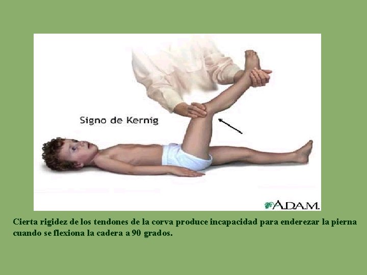 Cierta rigidez de los tendones de la corva produce incapacidad para enderezar la pierna
