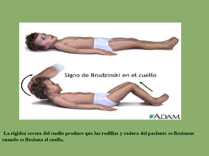  La rigidez severa del cuello produce que las rodillas y cadera del paciente
