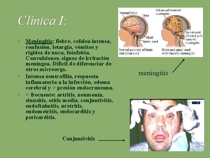 Clínica I: • Meningitis: fiebre, cefalea intensa, confusión, letargia, vómitos y rigidez de nuca,