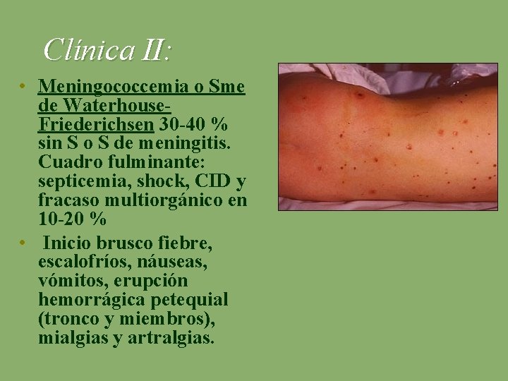 Clínica II: • Meningococcemia o Sme de Waterhouse- Friederichsen 30 -40 % sin S