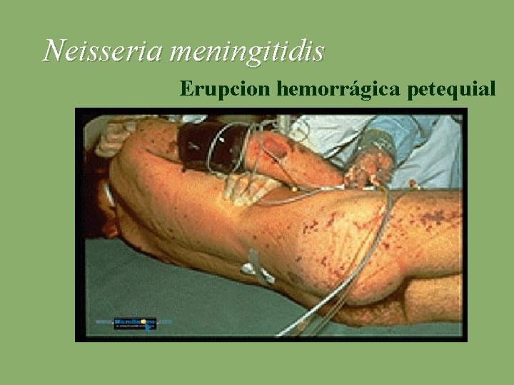 Neisseria meningitidis Erupcion hemorrágica petequial 