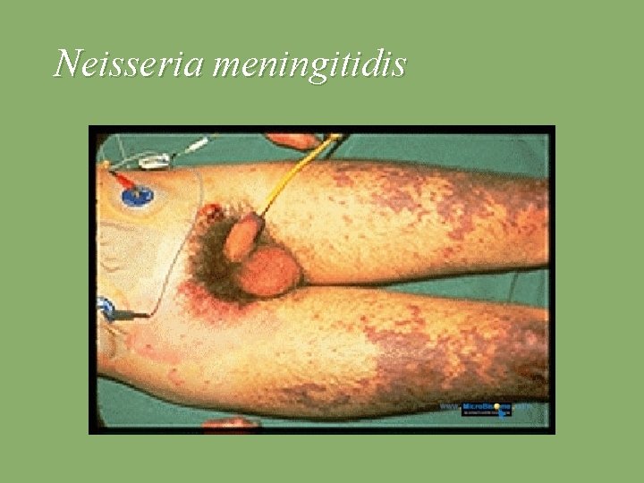 Neisseria meningitidis 