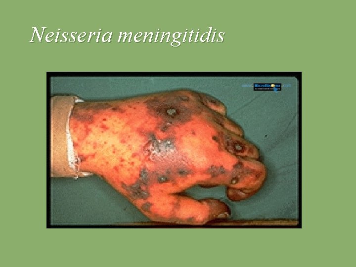 Neisseria meningitidis 