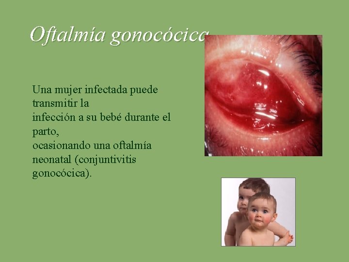 Oftalmía gonocócica Una mujer infectada puede transmitir la infección a su bebé durante el