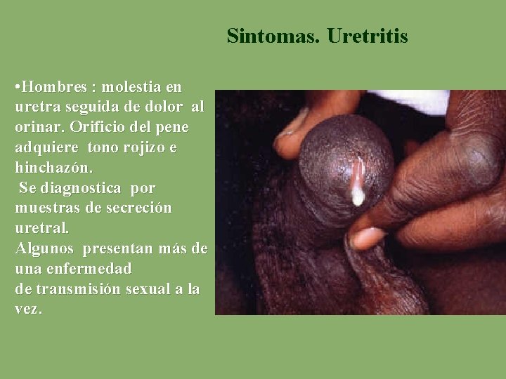 Sintomas. Uretritis • Hombres : molestia en uretra seguida de dolor al orinar. Orificio