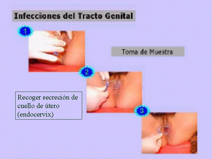 Recoger secreción de cuello de útero (endocervix) 