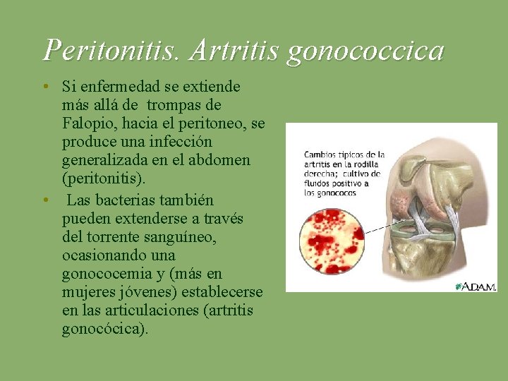 Peritonitis. Artritis gonococcica • Si enfermedad se extiende más allá de trompas de Falopio,