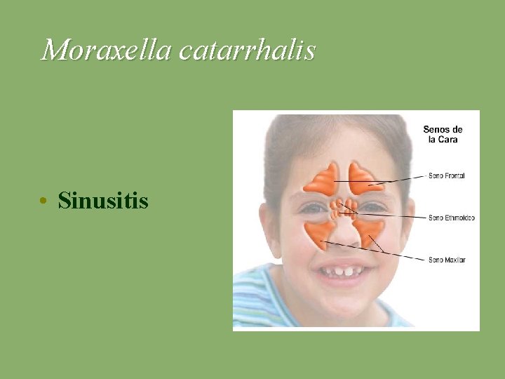 Moraxella catarrhalis • Sinusitis 