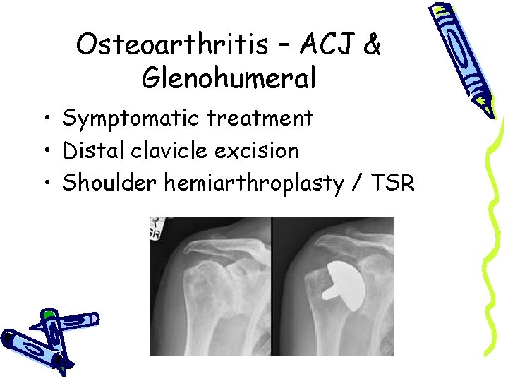 Osteoarthritis – ACJ & Glenohumeral • Symptomatic treatment • Distal clavicle excision • Shoulder