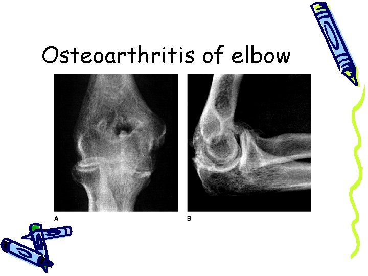 Osteoarthritis of elbow 