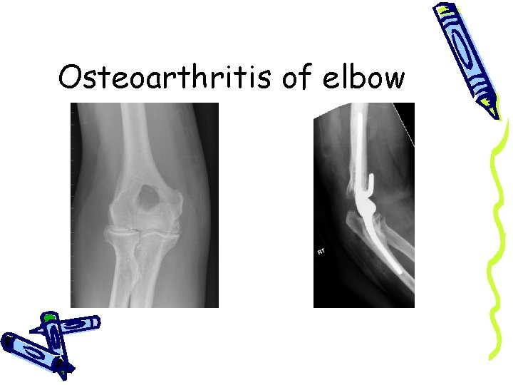 Osteoarthritis of elbow 
