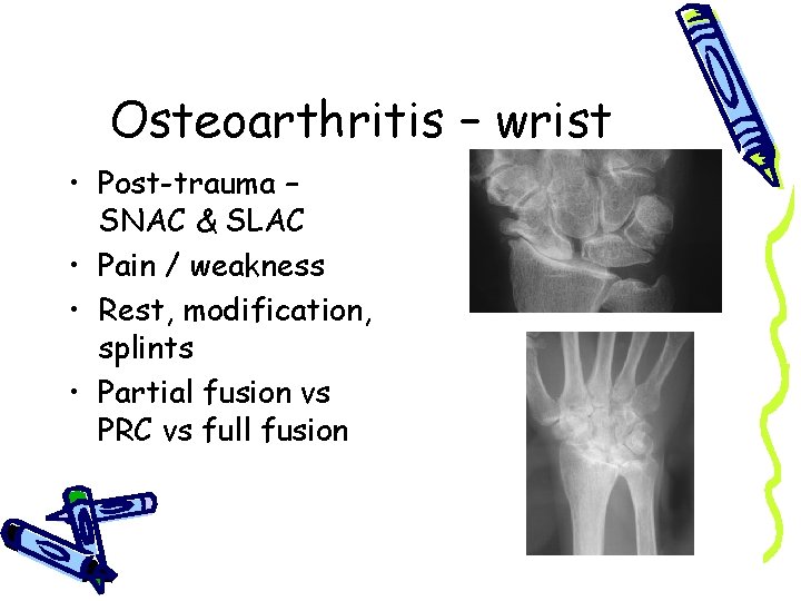Osteoarthritis – wrist • Post-trauma – SNAC & SLAC • Pain / weakness •