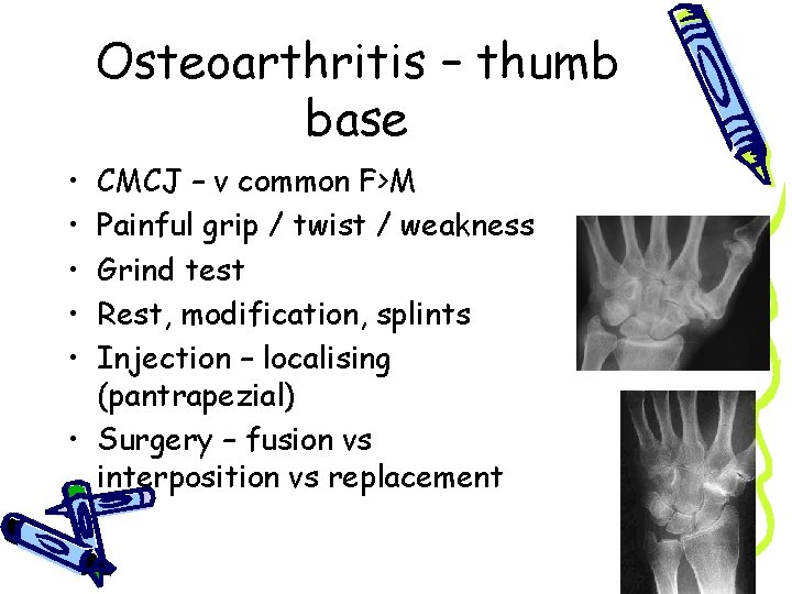 Osteoarthritis – thumb base • • • CMCJ – v common F>M Painful grip