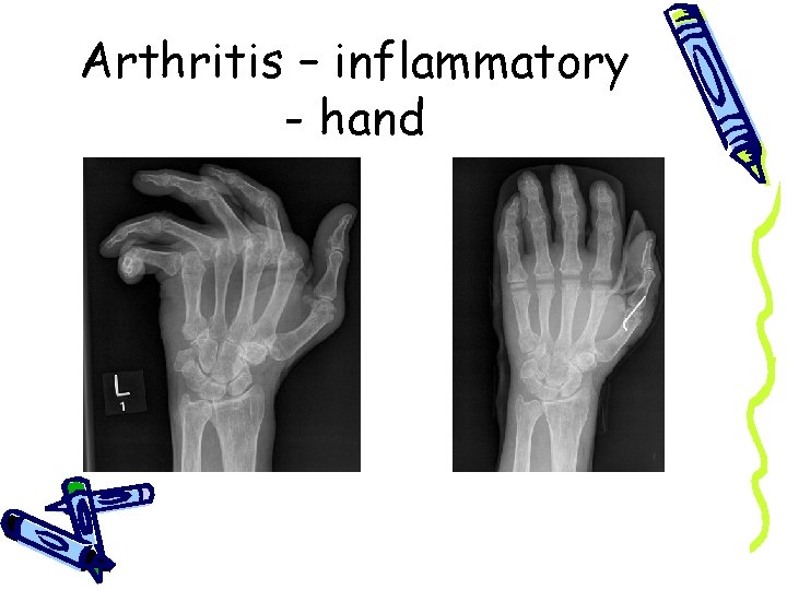 Arthritis – inflammatory - hand 