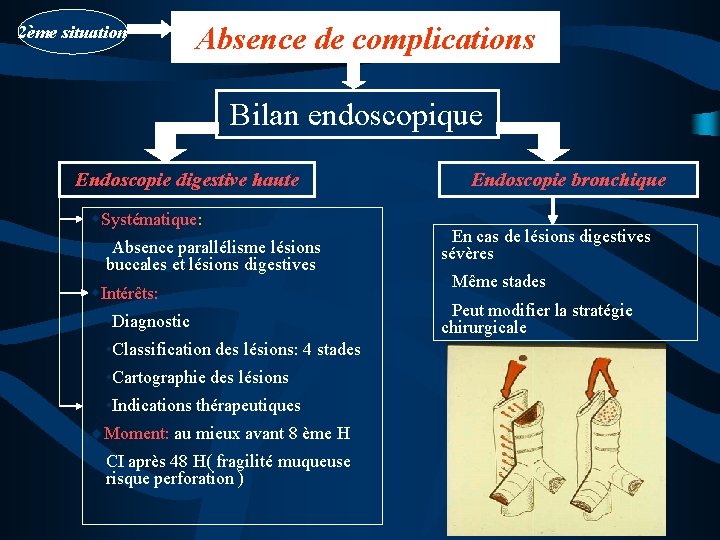 2ème situation Absence de complications Bilan endoscopique Endoscopie digestive haute w. Systématique: • Absence